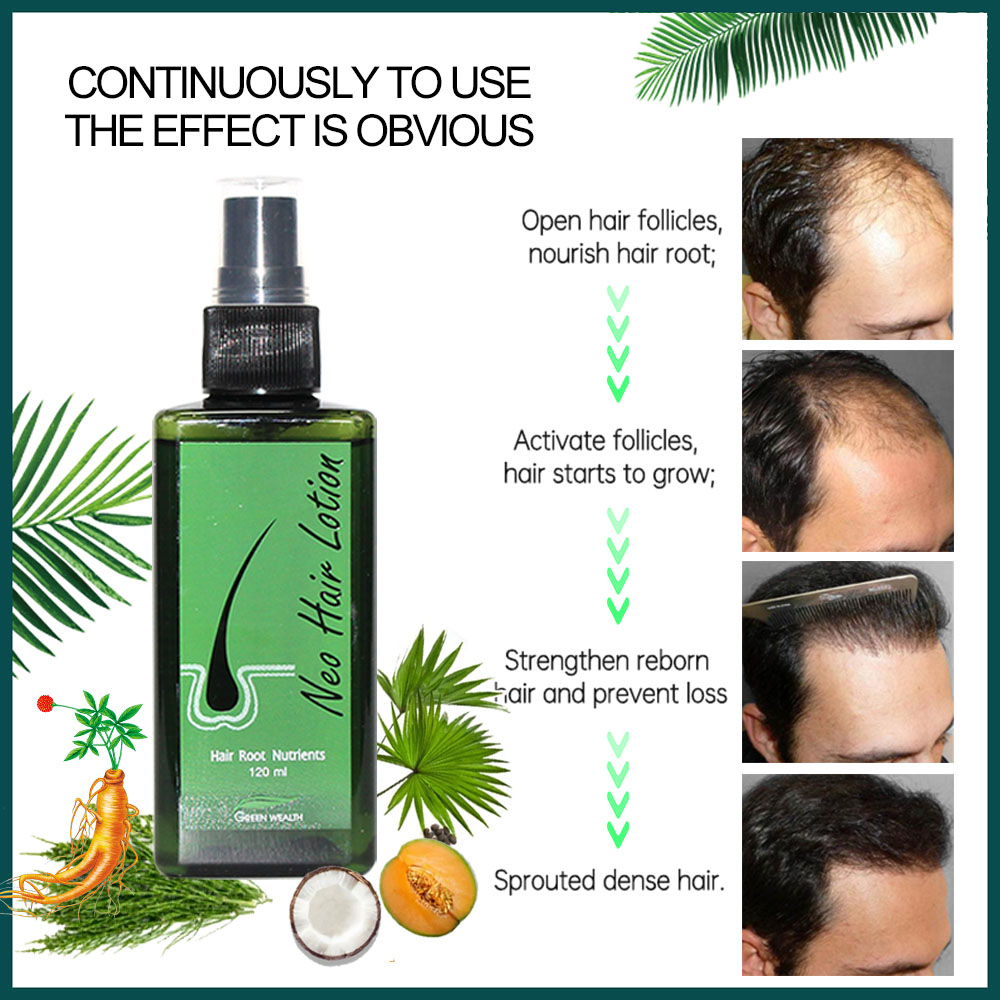 4 pezzi Neo Hair Lotion 120ml  - Nutrition And Fitness recensione e prezzo